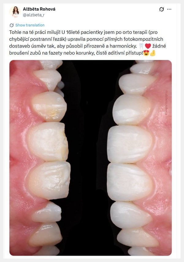 Dostavba chrupu fotokompozitem u 16leté pacientky