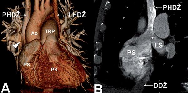 Obr. 12 – Defekt septa síní typu sinus venosus superior (*) s anomálním návratem plicních žil (šipka) do horní duté žíly. Defekt mezi pravou (PS) a levou síní (LS) je při vústění pravostranné horní duté žíly (PHDŽ) do pravé síně. Navíc jako varieta je u pacienta přítomna perzistující levostranná horní dutá žíla (LHDŽ), která ústí do koronárního sinu. Aorta (Ao), truncus pulmonalis (TRP) a dolní dutá žíla (DDŽ).