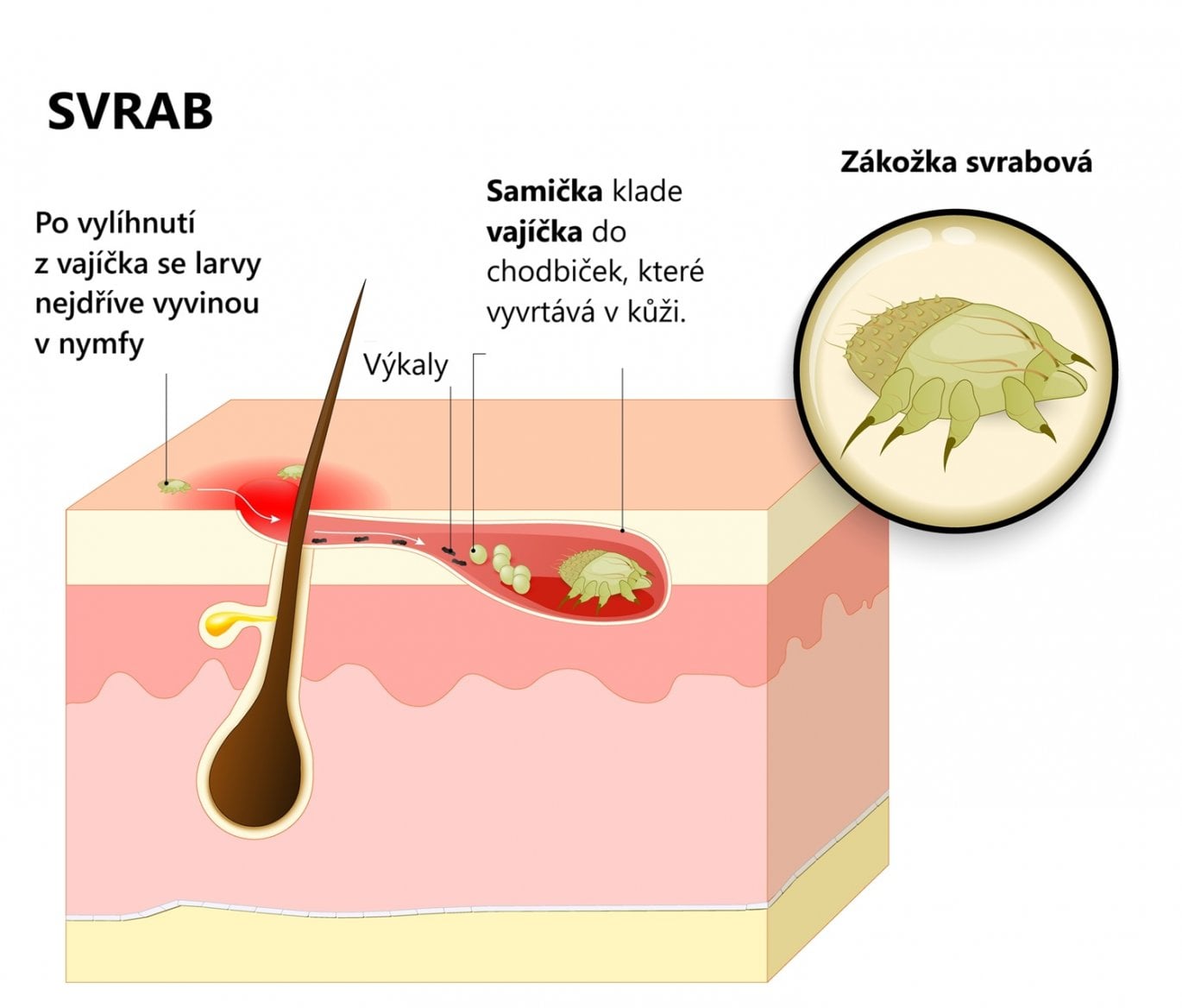 Zákožka svrabová hloubící si chodbičku v kůži, kam klade vajíčka - příčina úporného svědění