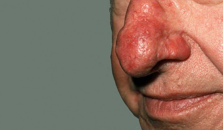 Rosacea (růžovka)