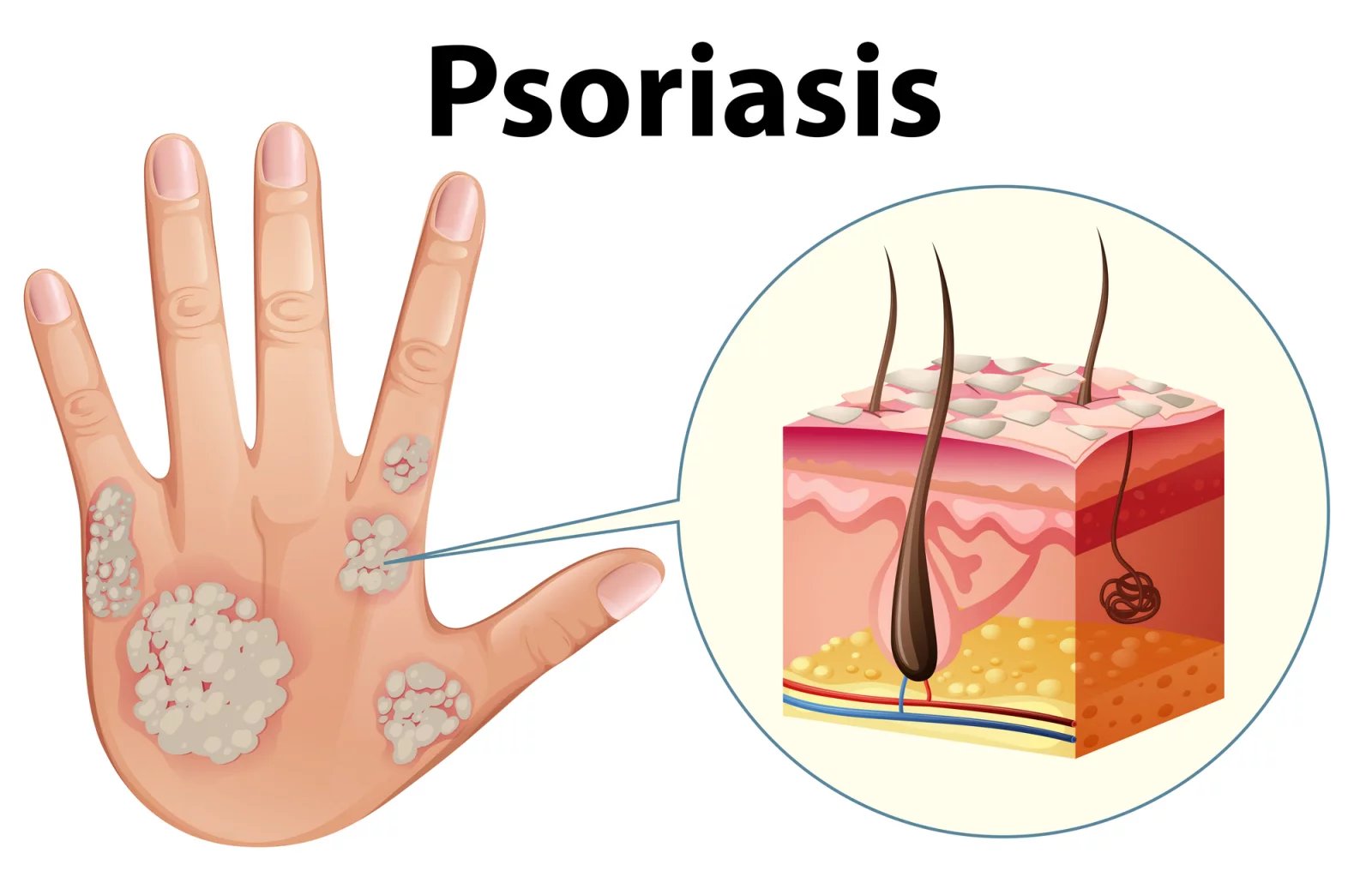 Lázně Smrdáky se specializují mimo jiné na léčbu lupénky neboli psoriázy