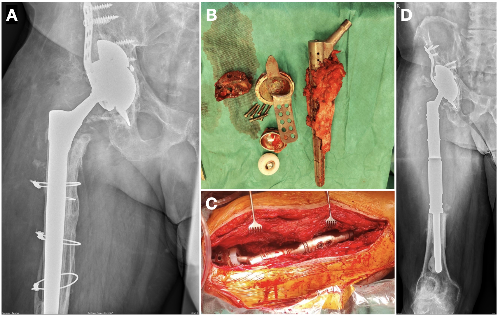 Modulární megaprotéza dokáže nahradit i celé úseky zničené kosti