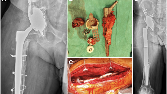 Modulární megaprotéza dokáže nahradit i celé úseky zničené kosti