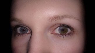 heterochromie