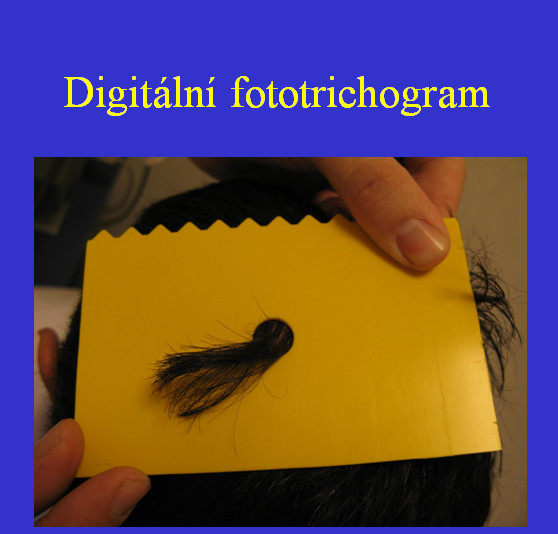 Alopecia areata: Když vlasy padají po trsech