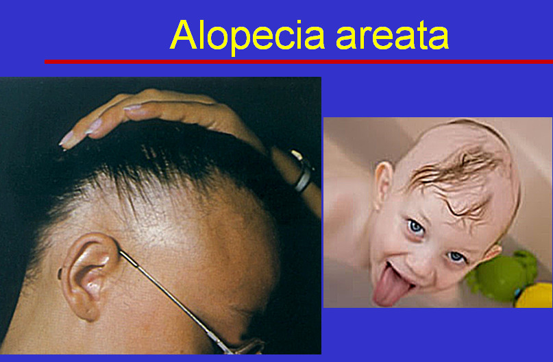 Alopecia areata: Když vlasy padají po trsech