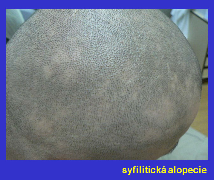 Alopecia areata: Když vlasy padají po trsech