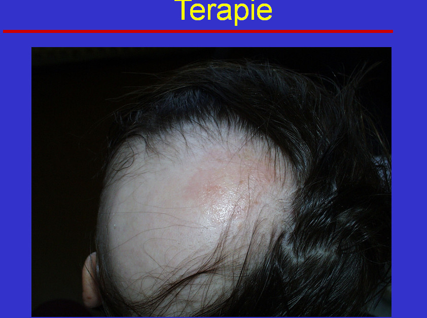 Alopecia areata: Když vlasy padají po trsech