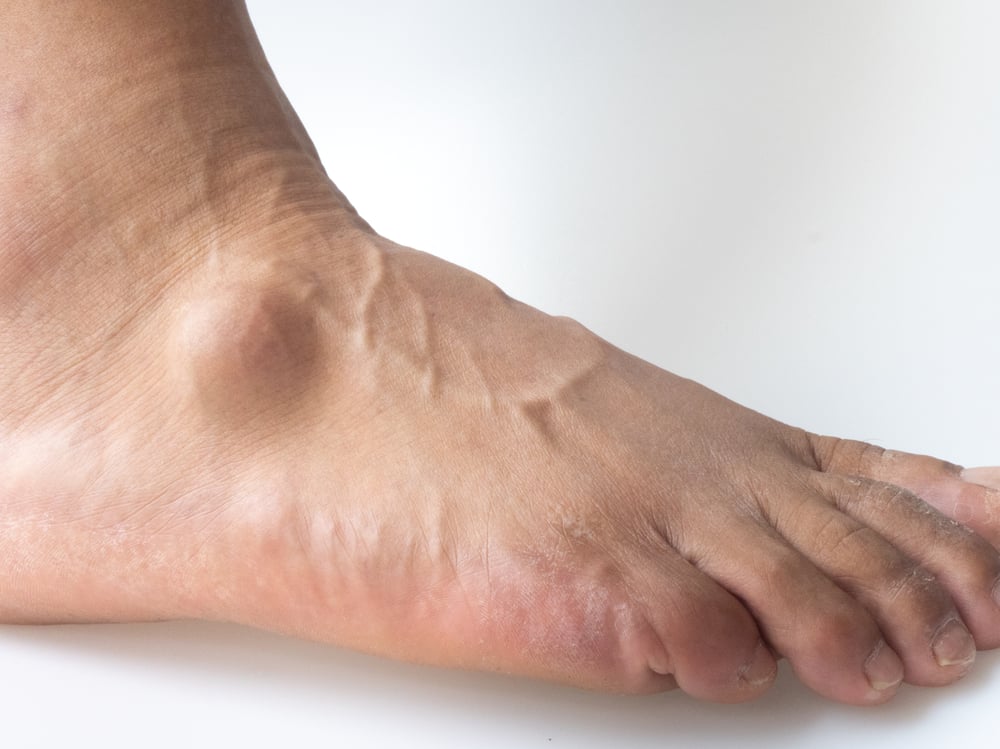 Ganglion se může udělat i kolem kloubů na noze
