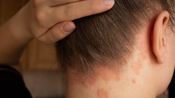 Detail ženské vlasové části hlavy s lupénkou