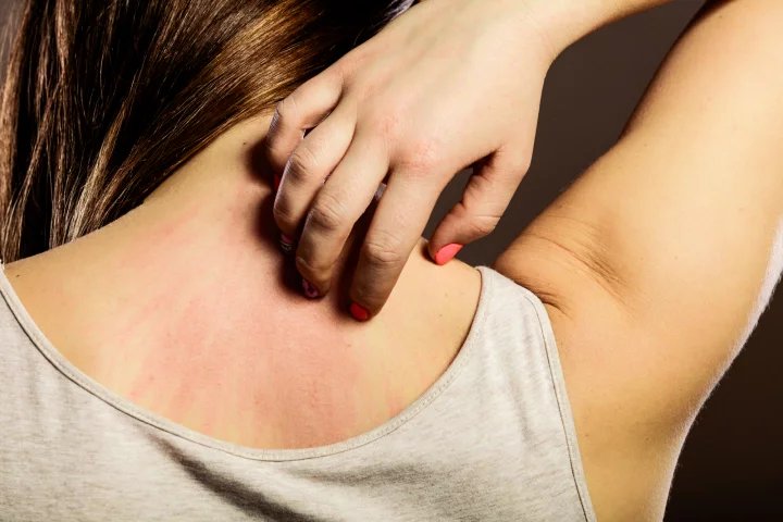 Vyrážka, v lékařských kruzích označovaná jako dermatitida, je opuchlá nebo podrážděná oblast na kůži. V závislosti na příčině pak mohou být dermatitidy bolestivé, pálivé či svědivé.