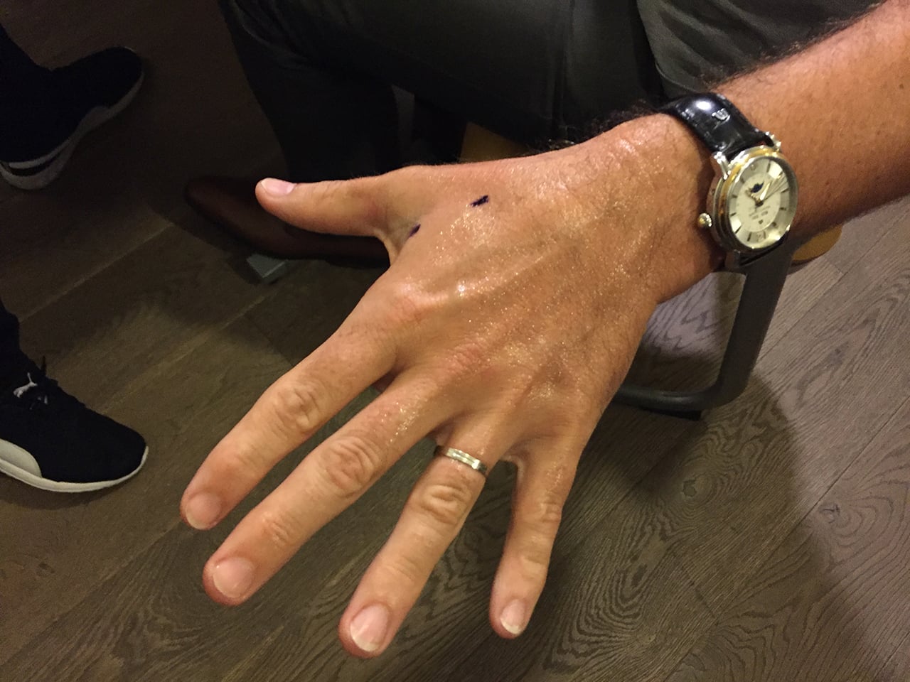 Postříkání dezinfekcí před zákrokem.