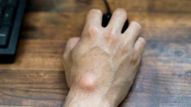 Ganglion patrný na hřbetě zápěstí mužské ruky