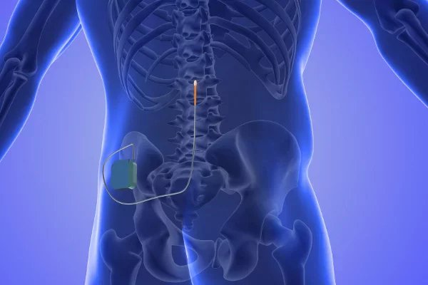 Takto vypadá zjednodušené schéma terapie. V páteři je jedna elektroda (někdy mohou být dvě), na boku má pacient neurostimulátor.