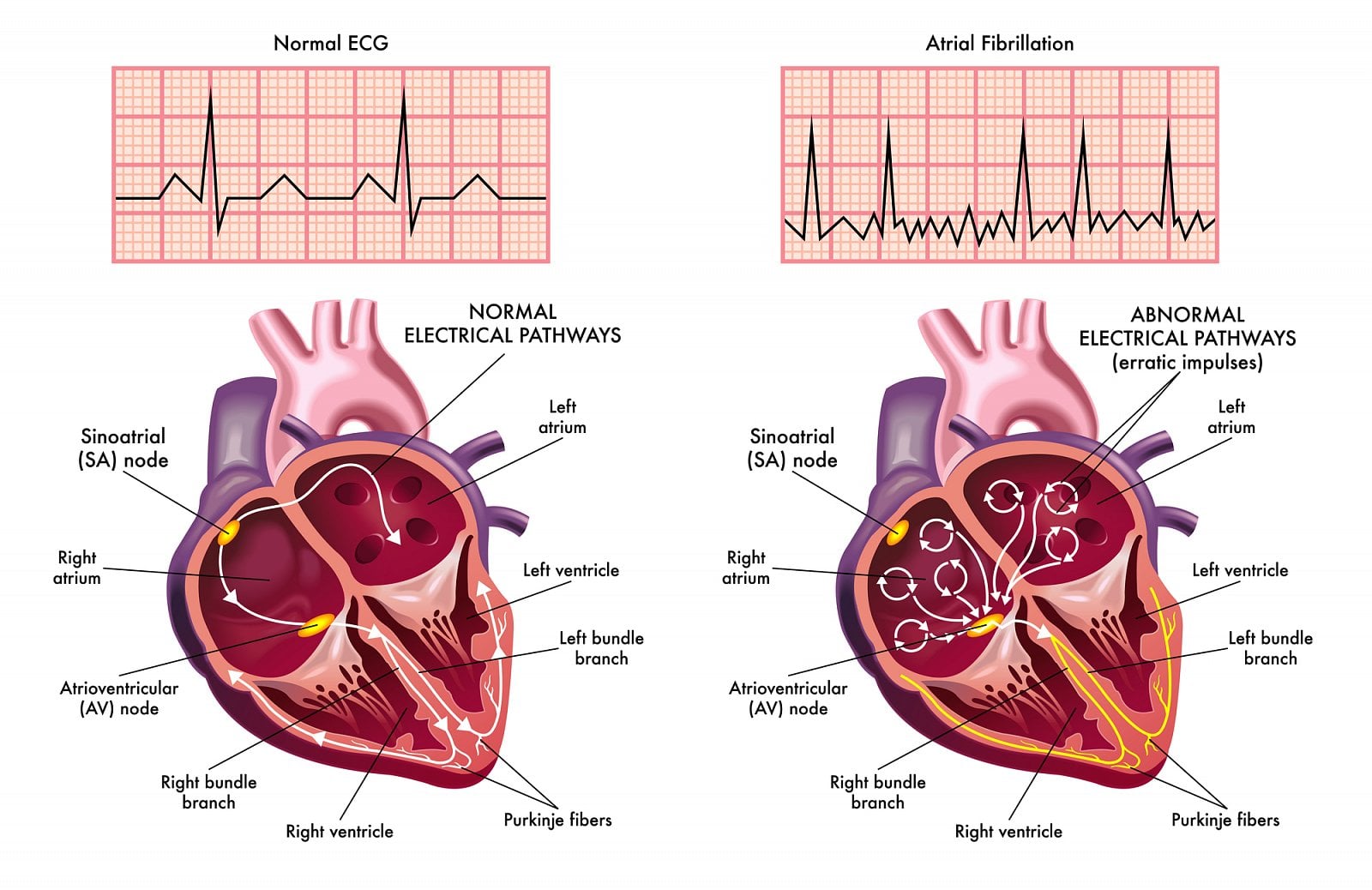 Vlevo normální EKG, vpravo to s fibrilací síní