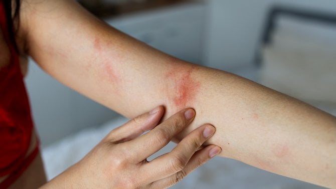 opruzeniny opruzenina vyrážka ekzém ruka loket kůže