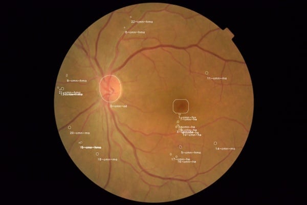 Patologické změny na sítnici, způsobené diabetickou retinopatií. Pokud pacient diabetickou retinopatii nemá, tyto změny se na sítnici nevyskytují.