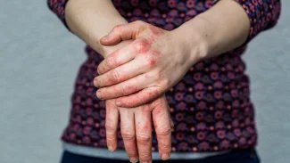 Náhledový obrázek - Dyshidrotický ekzém postihuje nejčastěji ruce a chodidla. Hlavními spouštěči jsou stres a alergeny