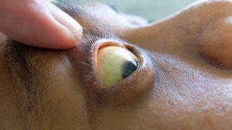 Náhledový obrázek - Žloutenka typu B je celosvětově nejčastější virové onemocnění jater. Přenáší se tělesnými tekutinami