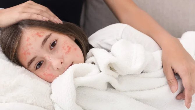 Holčička s vyrážkou v obličeji