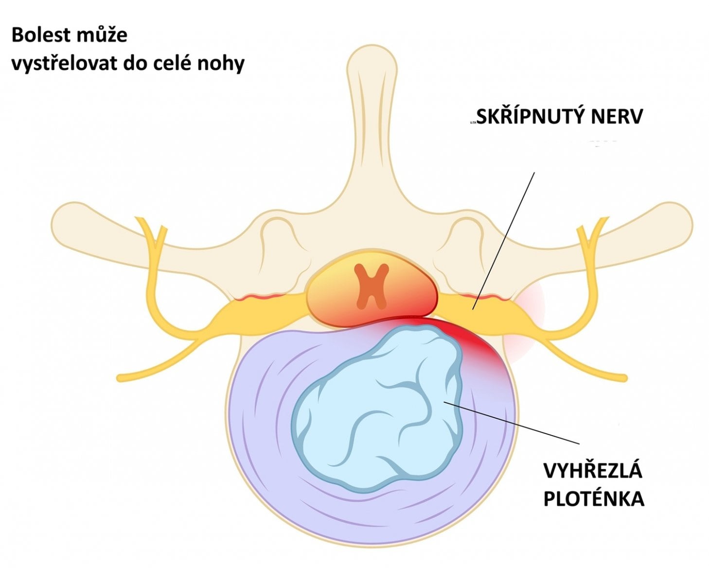 Skřípnutý nerv v bederní páteři, na jehož bolest může zabrat obstřik zad