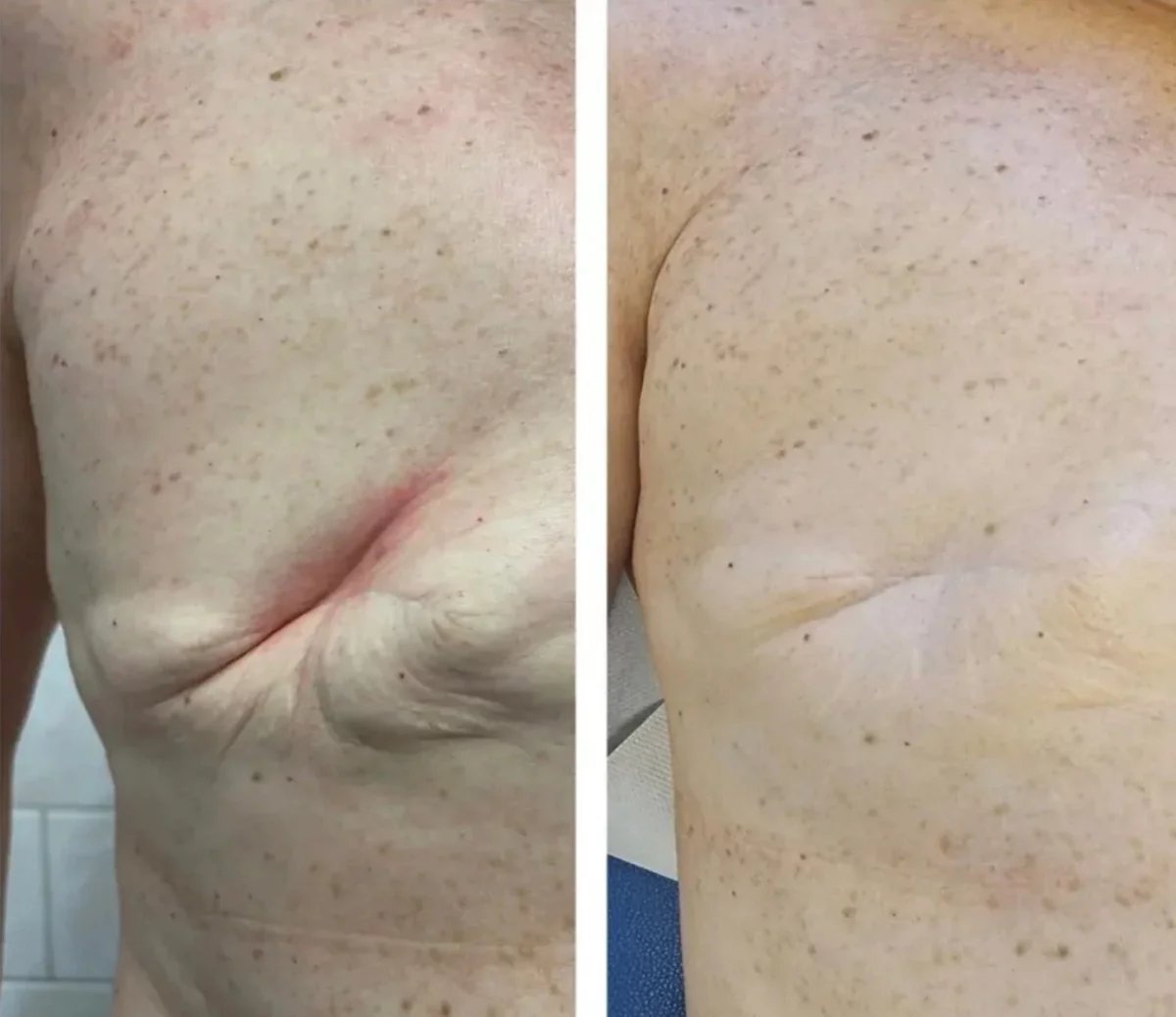 Důležité není jizvy ošetřit jen v ordinaci fyzioterapeuta, ale ženu především poučit, jak si má každou z nich ošetřovat doma. Bez domácí péče by jizva nemohla vypadat jako ta, kterou vidíte vpravo.