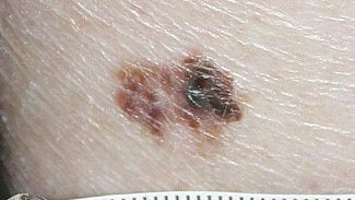 Náhledový obrázek - Ve Stanu proti melanomu v Praze zjistili lékaři 21 melanomů