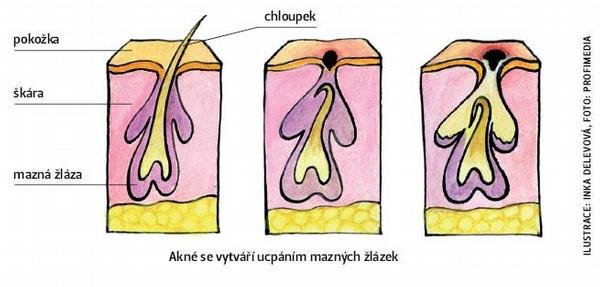 Akné se vytváří ucpáním mazných žlázek