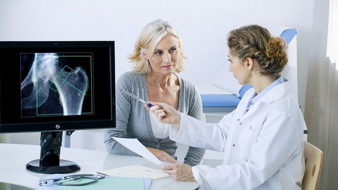 Při osteoporóze dochází k řídnutí kostní tkáně. Na vině může být špatná životospráva