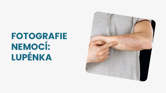 Náhledový obrázek - Lupénka foto: jak vypadá psoriáza a kde na těle se nejčastěji projevuje?