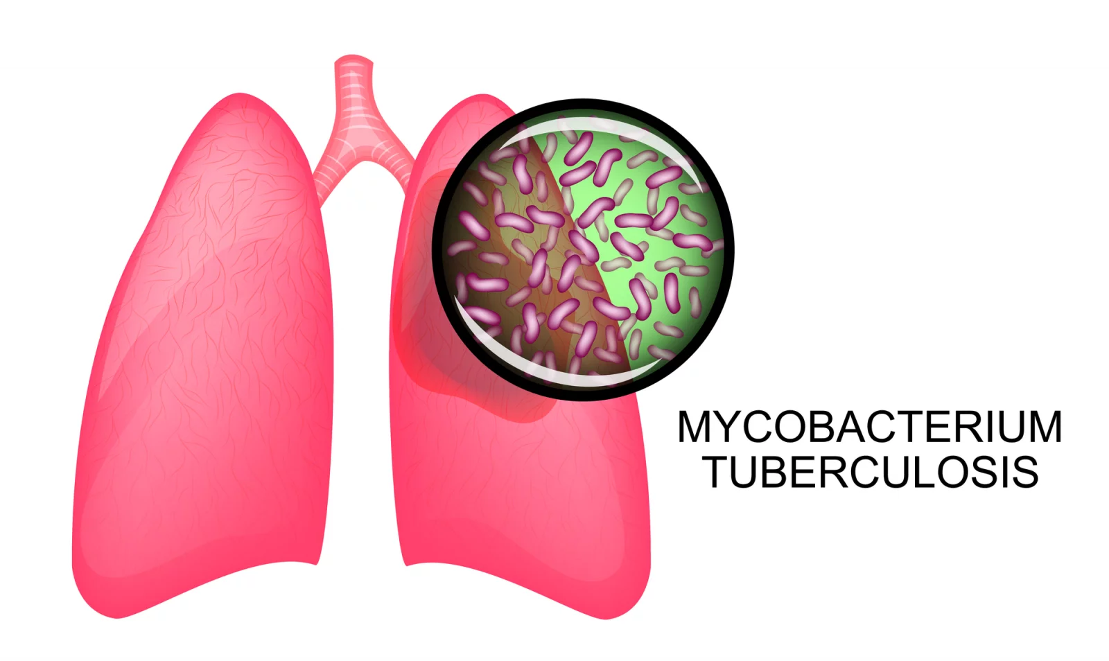 Co všechno je dobré vědět o tuberkulóze