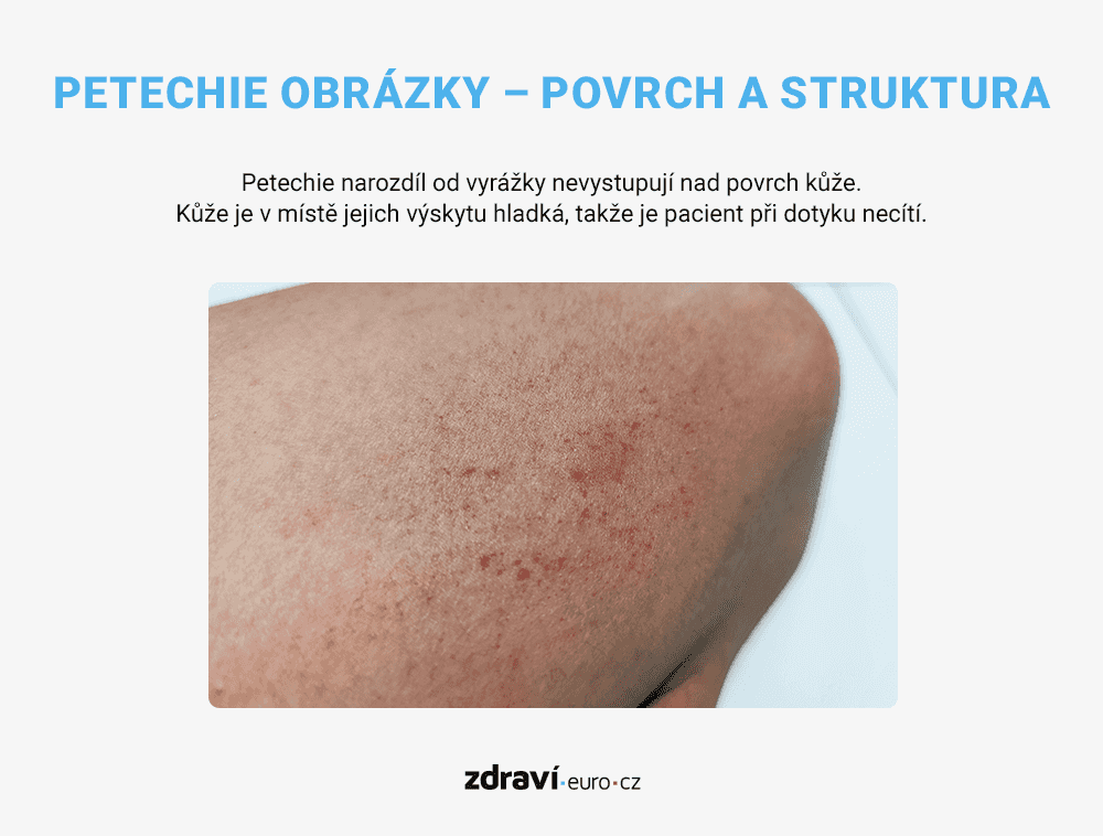 Petechie obrázky