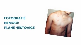 Náhledový obrázek - Plané neštovice obrázky a fotografie – Jak poznat toto vysoce nakažlivé onemocnění?