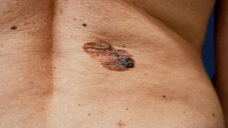 Náhledový obrázek - Počet nemocných kožním melanomem stále vzrůstá