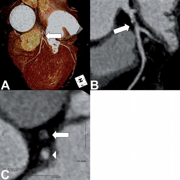 Obr. 5 – CT koronarografie preobliterační stenózy ramus interventricularis anterior. A) V zobrazení 3D VRT dobře hodnotitelná anatomie, stenóza je v krátkém proximálním úseku před odstupem první diagonální větve (šipka). B) V zakřivené planární rekonstrukci je zjevné, že se jedná o smíšený plát a stenóza je tvořena měkkou částí plátu (šipka). Je pravděpodobné, že se jedná o trombus nasedající na plát. C) Zobrazení kolmé na osu tepny umožňuje plošné hodnocení lumen tepny podobně jako intravaskulární ultrazvuk, avšak s nižším prostorovým rozlišením. Na průřezu zobrazen r. interventricularis ant. (šipka) i ramus circumflexus (hlava šipky).