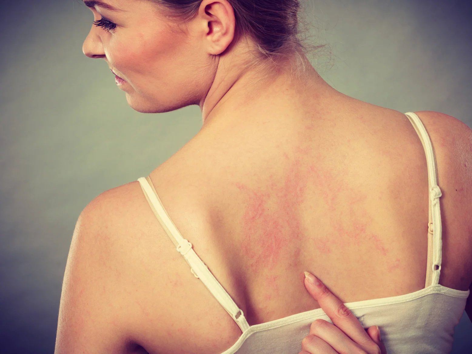 Pokud vás postihne alergická dermatitida, zkuste se zamyslet, zda vaše kůže nepřišla do kontaktu s některým z běžných alergenů, jako je například nikl nebo některá z rostlin. Mezi alergeny řadíme i léky nebo konzervační látky.