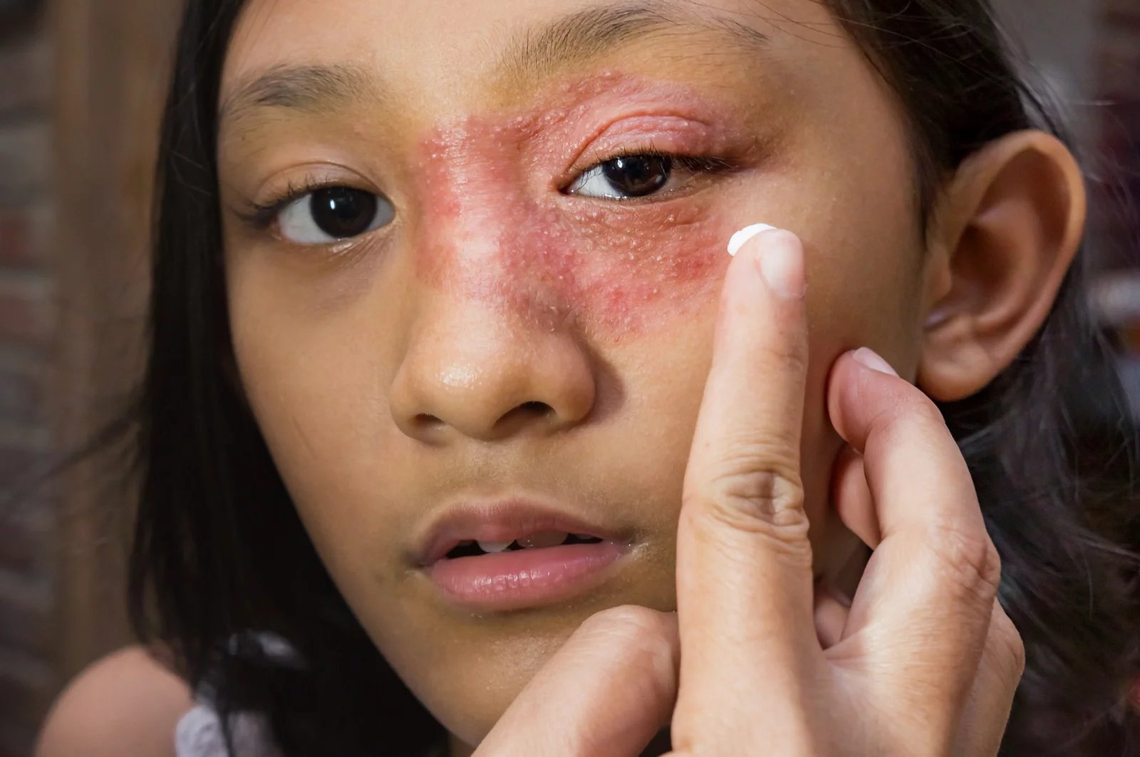 Ze skupiny ekzémů je nejobvyklejší vyrážkou atopická dermatitida, která bývá z velké části podmíněna genetikou. Hodně na ni trpí děti, nicméně s věkem se stav tohoto ekzému obvykle zlepšuje.