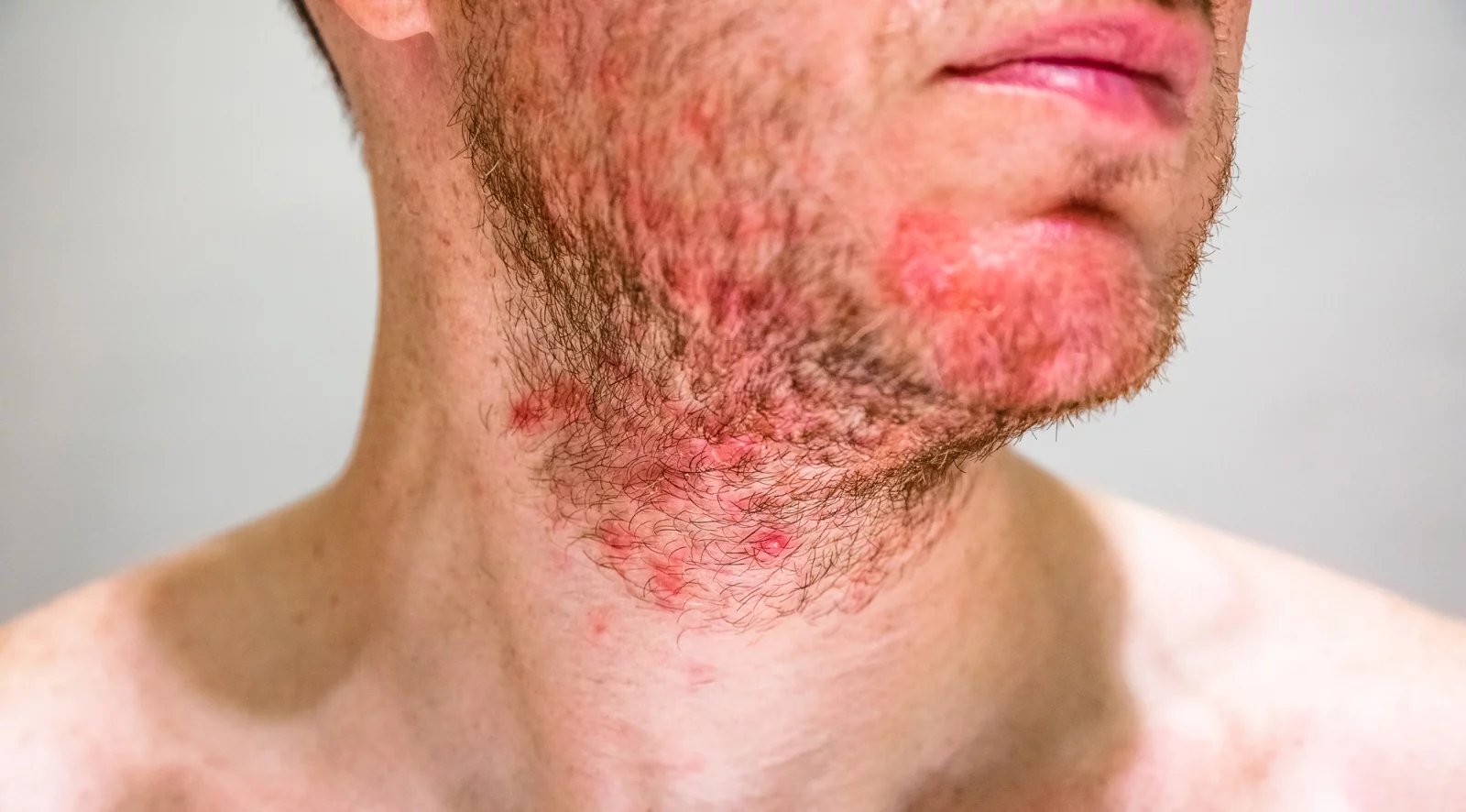 Seboroickou dermatitidou trpí přibližně 12 procent obyvatelstva. Jde o chronickou nemoc, která se běžně objevuje na obličeji, zádech, ale i hlavě. Projevuje se zejména zčervenáním postiženého místa.