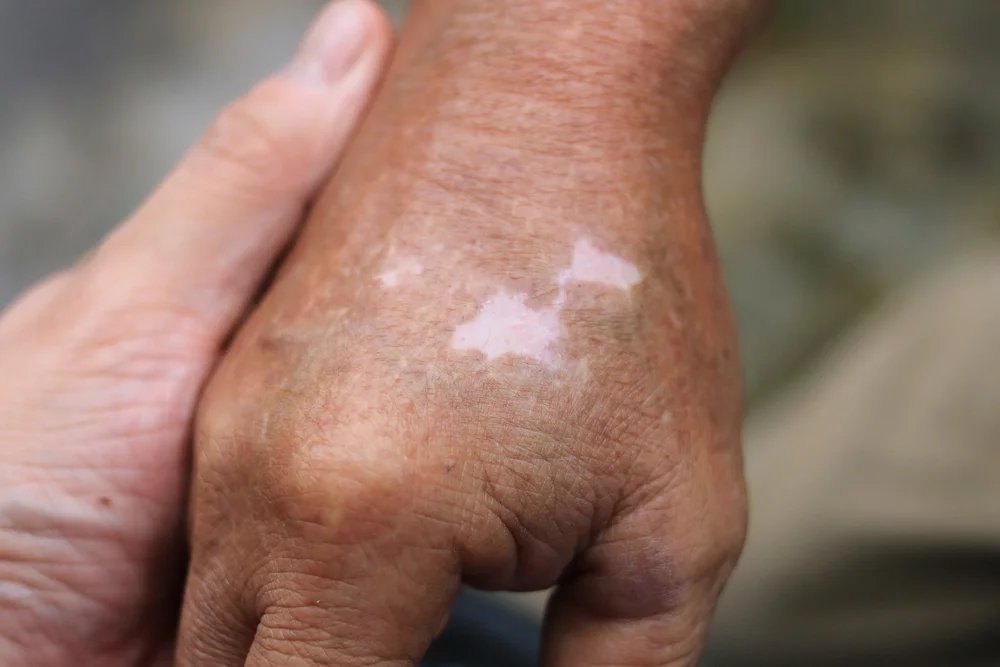 Existuje poměrně dost terapeutických postupů na zmírnění projevů této nemoci. Bohužel ale není zcela vyléčitelná.