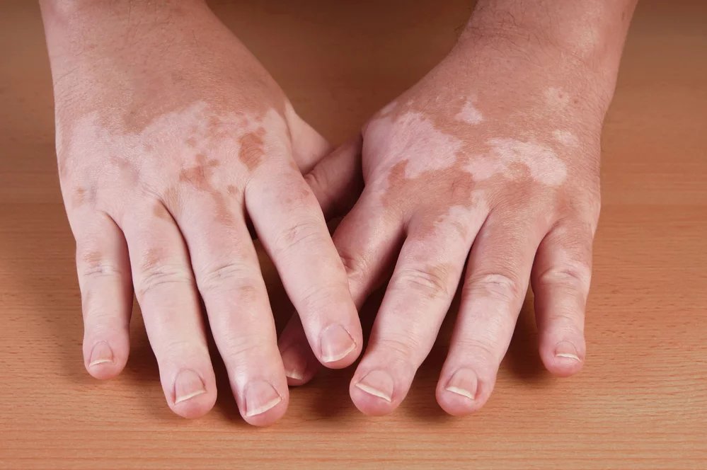 Nejrozšířenějším typem tohoto onemocnění je generalizované vitiligo. Skvrny bývají rozesety kolem úst a očí, na prstech, kolenou či v okolí genitálií. První bílé skvrny se u většiny pacientů objeví ještě před dovršením 20 let.