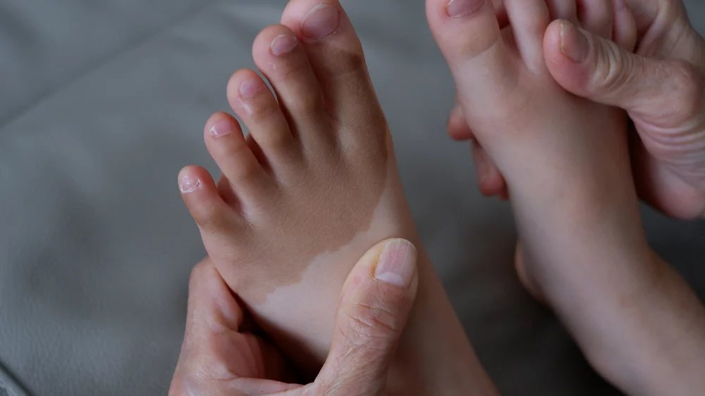 U rozsáhlých forem vitiliga lze používat i léčbu laserem. Případně lze přistoupit i k chirurgické léčbě, při které jsou pacientovi transplantovány kožní štěpy, či přímo melanocyty.
