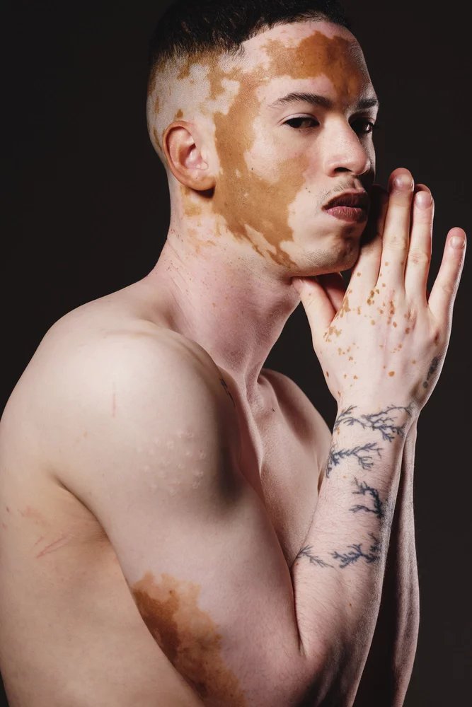 Nemoc vitiligo se objevuje jen vzácně u dětí mladších 8 let. Mnohem častěji postihuje děti ve věkovém rozmezí 9–12 let. Během puberty může psychika dospívajícího jedince hodně utrpět, pokud se vitiligo rozšíří na viditelná místa.
