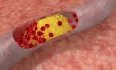 Jako zlý cholesterol se označuje takzvaný low density lipoprotein (LDL cholesterol). Jde právě o ten cholesterol, který má při nadbytku sklon usazovat se v cévách. Normální hodnoty LDL cholesterolu jsou do 3,4 mmol/l. Jakmile překročí 4,1 mmol/l, hovoříme o vysoce rizikových hodnotách.