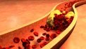 Jakmile výskyt cholesterolu v krvi přesáhne fyziologickou hranici, vzniká problém. Při zvýšené míře cholesterolu v krvi dochází k ukládání tukových částic na stěny cév. Důsledkem je ztráta jejich pružnosti a zúžení. Hovoříme pak o ateroskleróze.