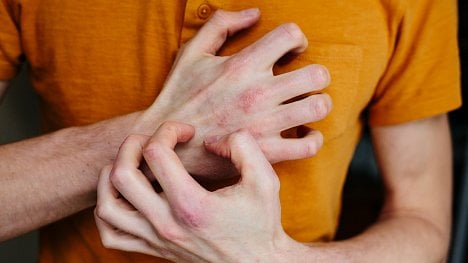 Atopický ekzém u dospělých se někdy léčí antibiotiky, pomáhá i drahá biologická léčba