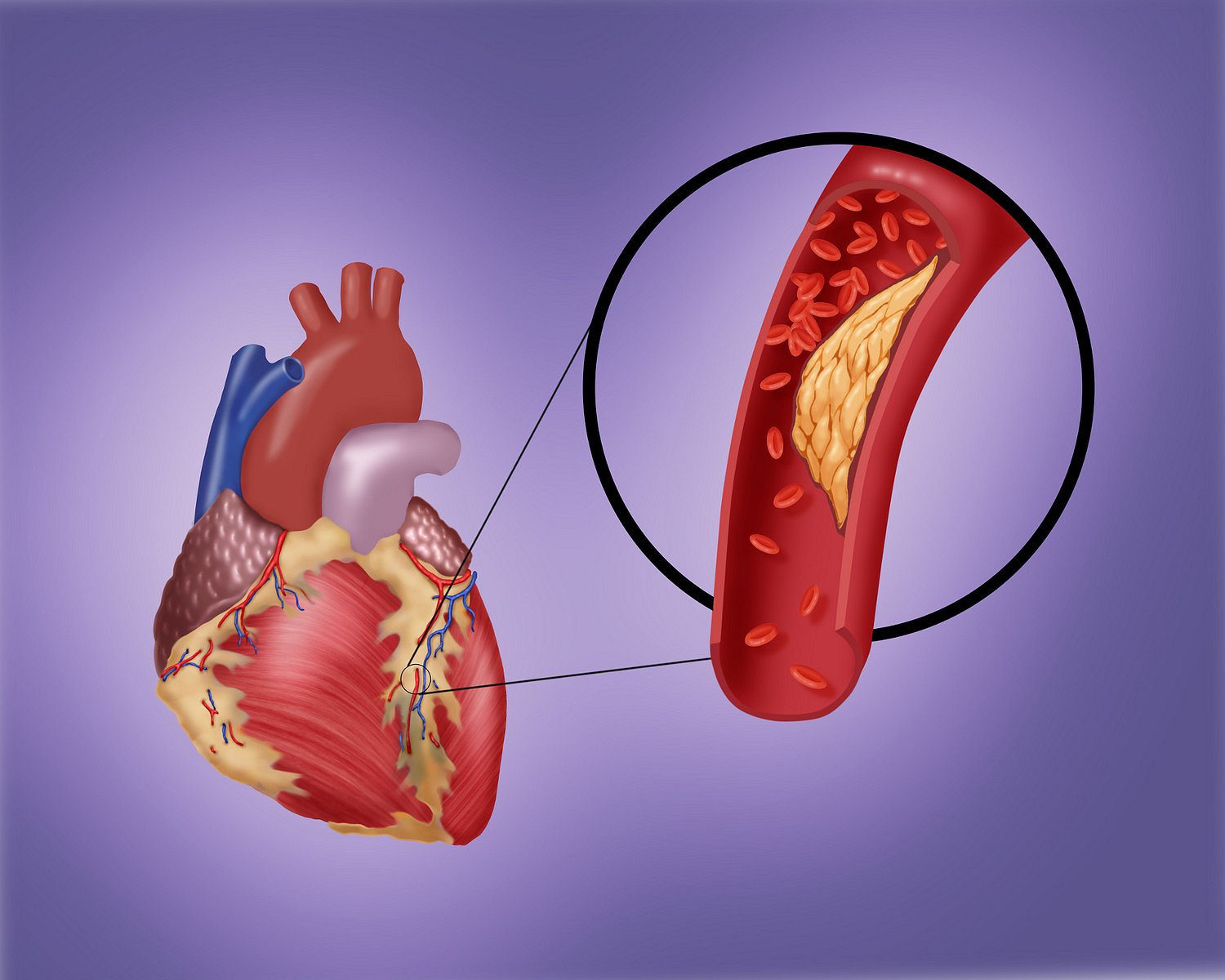 Vrozený vysoký cholesterol - familiární hypercholesterolémie FH