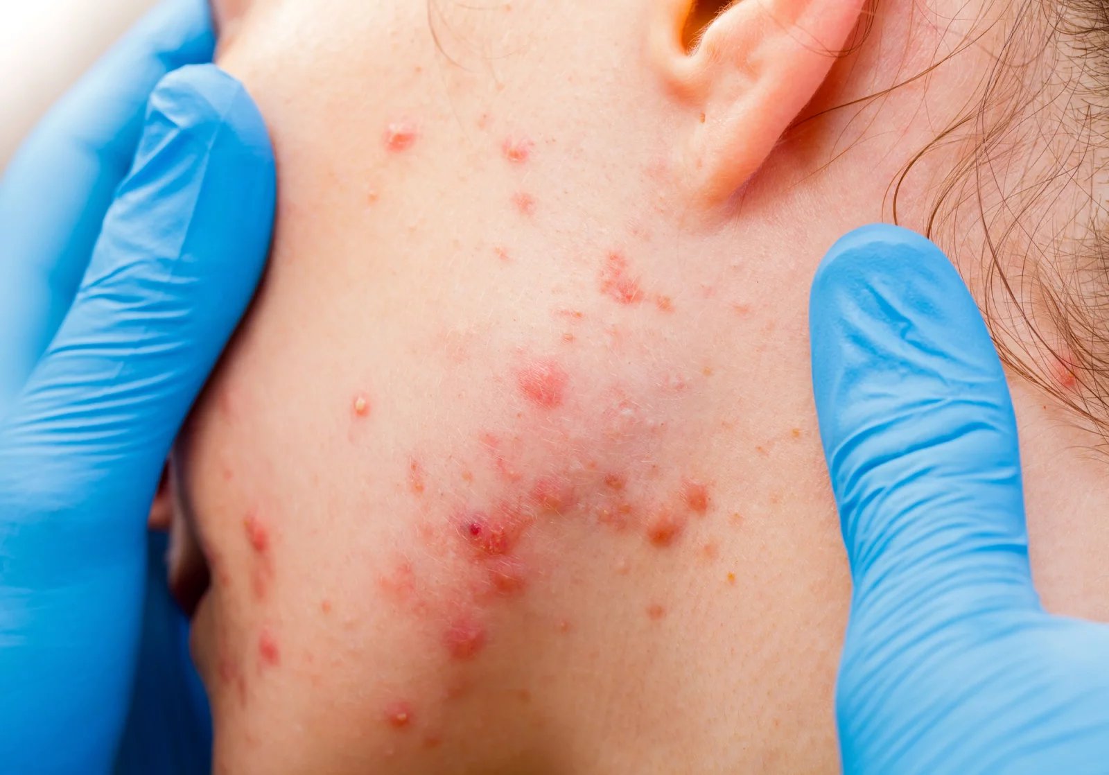 Podkožní akné je hovorový výraz pro dermatózu střední intenzity. Ta se projevuje malými podkožními hrudkami naplněnými mazem.