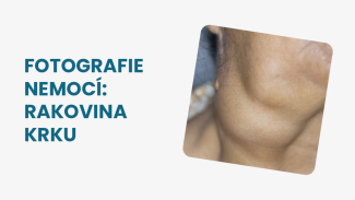 Náhledový obrázek - Rakovina krku foto: jejím typickým projevem je bulka na krku. Často se dostavuje také chrapot