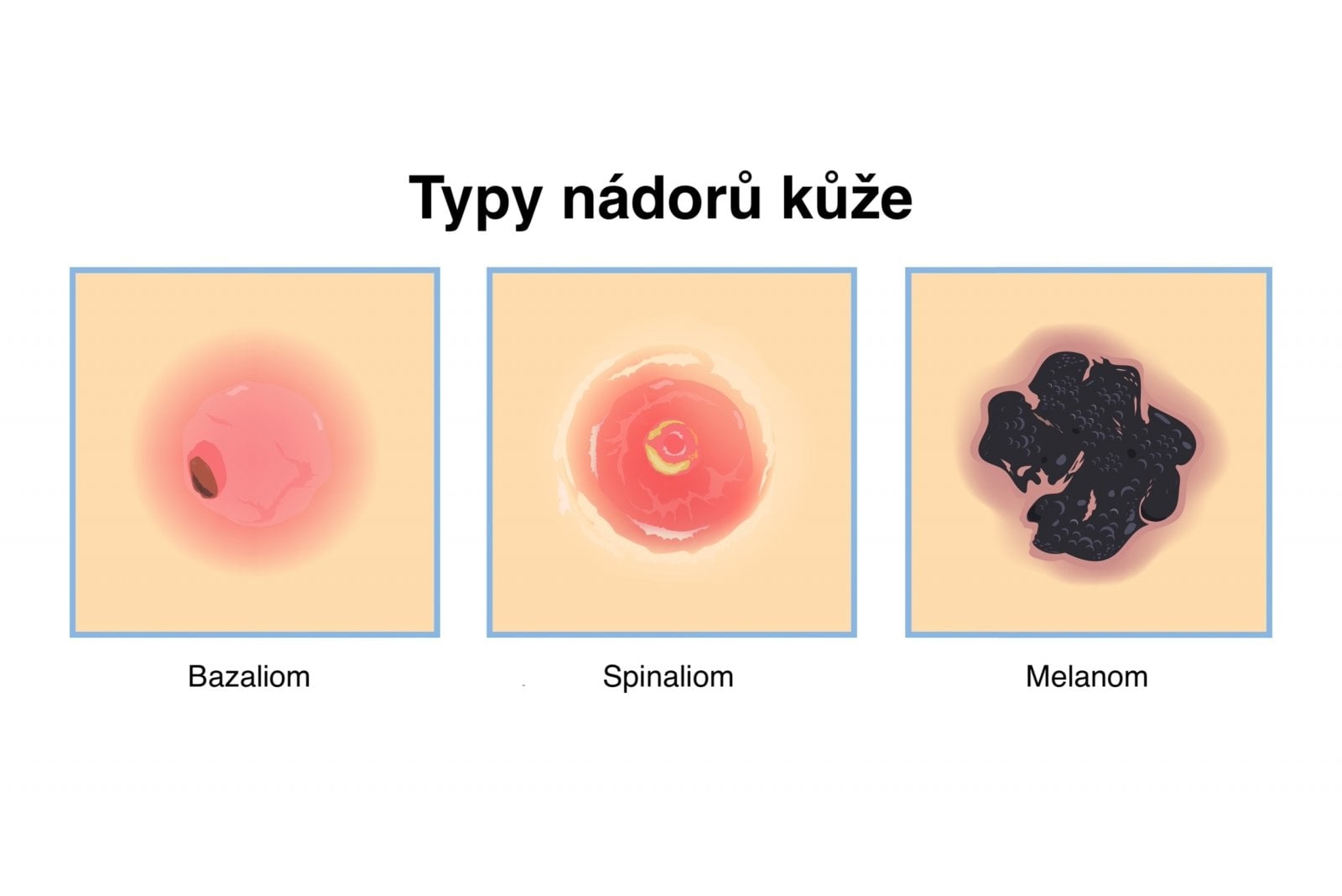 Jak vypadá bazaliom