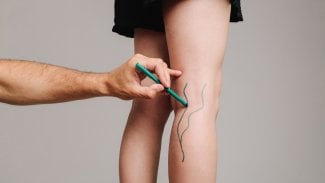 Náhledový obrázek - Trombóza postihuje hlavně dolní končetiny. Odhalte příznaky včas